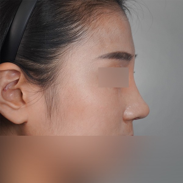 코재수술(콧대,코끝 실리콘+귀연골)