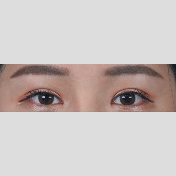 눈재수술(자연유착)